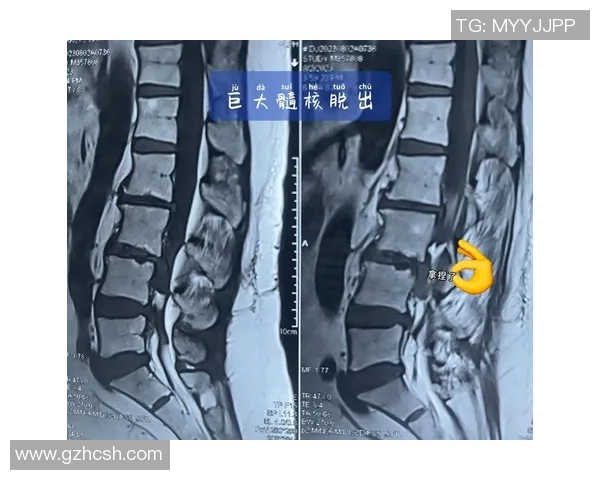 腰椎间盘问题困扰足球明星的职业生涯与恢复之路探讨